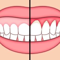 6 thói quen tốt cho răng